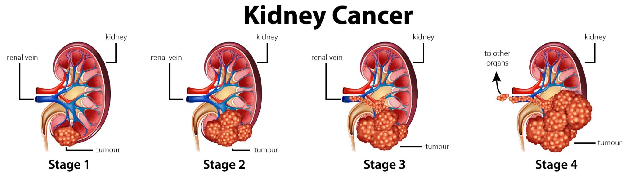 Kidney Cancer Symptoms, Diagnosis & Treatment Singapore