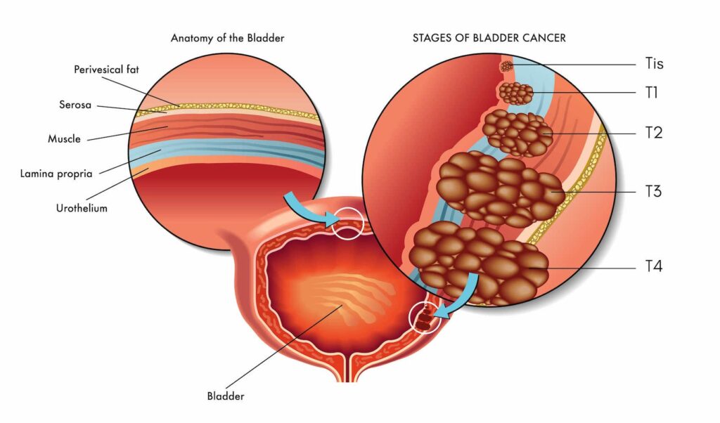 Giải phẫu và các giai đoạn của ung thư bàng quang